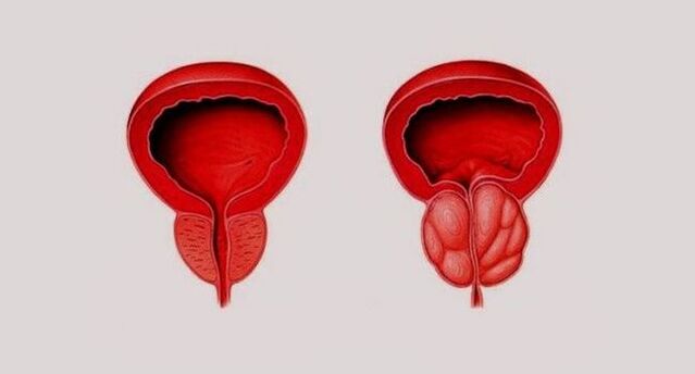 Healthy prostate (left) and inflammation due to prostatitis (right)