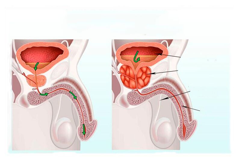the norms and inflammation of the prostate gland