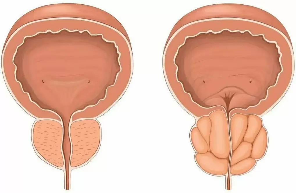 Normal prostate and prostate pain