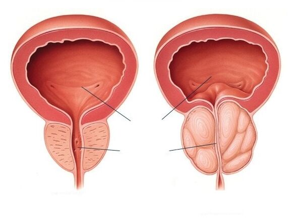 prostate is normal and enlarged