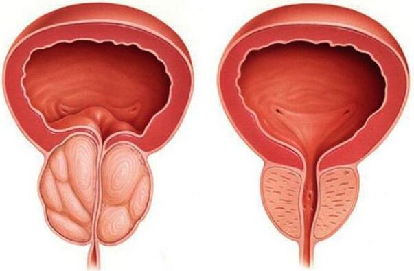 healthy prostate and inflamed with prostatitis
